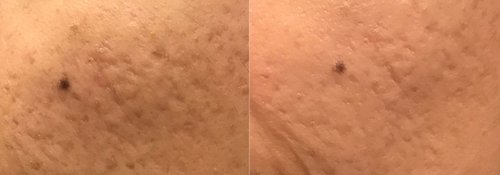Picosure / Laser Skin Rejuvenation Before and After - lr17