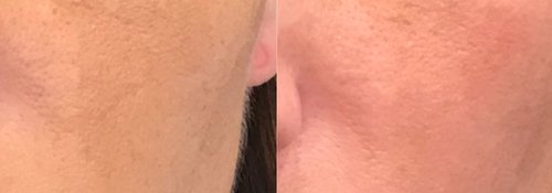 Picosure / Laser Skin Rejuvenation Before and After - lr2