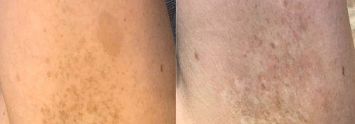 Picosure / Laser Skin Rejuvenation Before and After - lr3