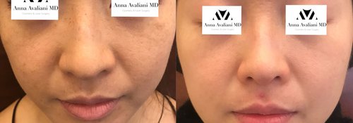 Picosure / Laser Skin Rejuvenation Before and After - lr4