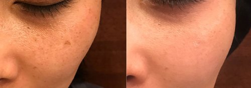Picosure / Laser Skin Rejuvenation Before and After - lr5