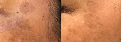 Picosure / Laser Skin Rejuvenation Before and After - lr6