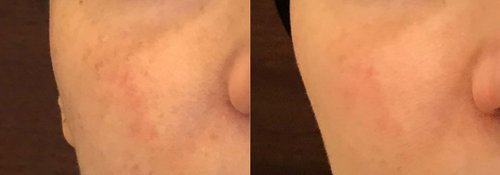 Picosure / Laser Skin Rejuvenation Before and After - lr7