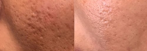 Picosure / Laser Skin Rejuvenation Before and After - lr8