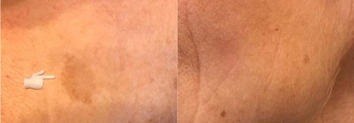 Picosure / Laser Skin Rejuvenation Before and After - lr9