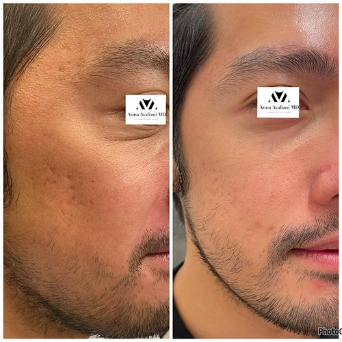 Microneedling Before and After - m1