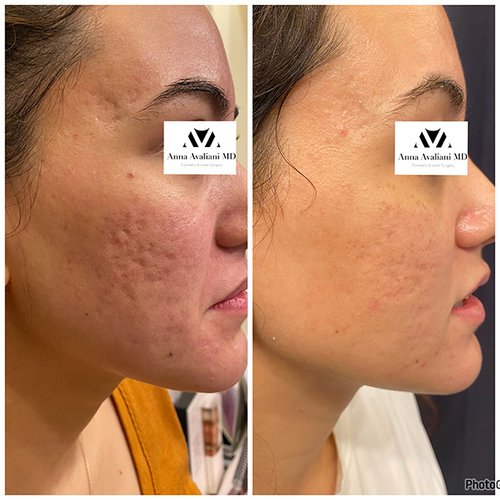 Microneedling Before and After - m2