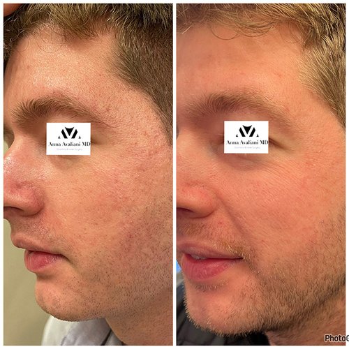 Microneedling Before and After - m3