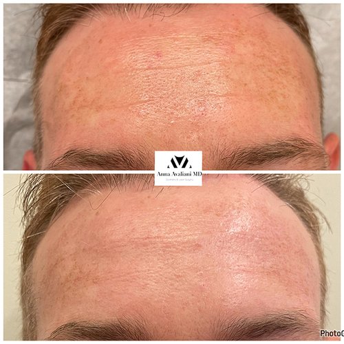 Microneedling Before and After - m4