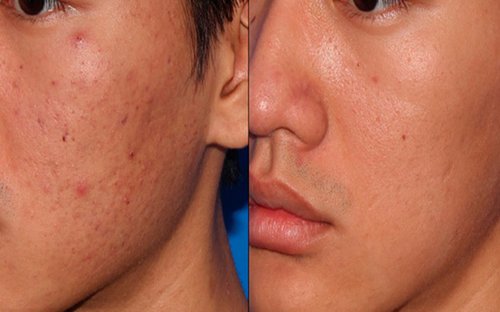 Microneedling Before and After - microneedling