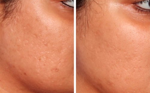 Microneedling Before and After - mp ba acne2 060715