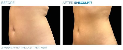Emsculpt NEO Before and After - neo edge1
