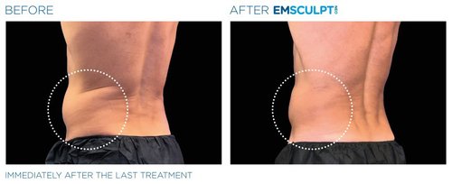 Emsculpt NEO Before and After - neo edge2