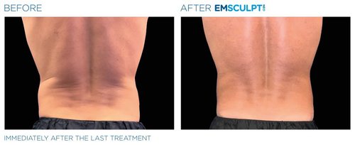 Emsculpt NEO Before and After - neo edge3