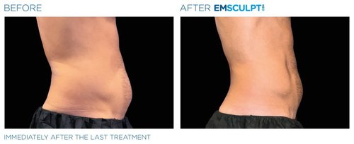 Emsculpt NEO Before and After - neo edge4