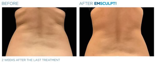Emsculpt NEO Before and After - neo edge5