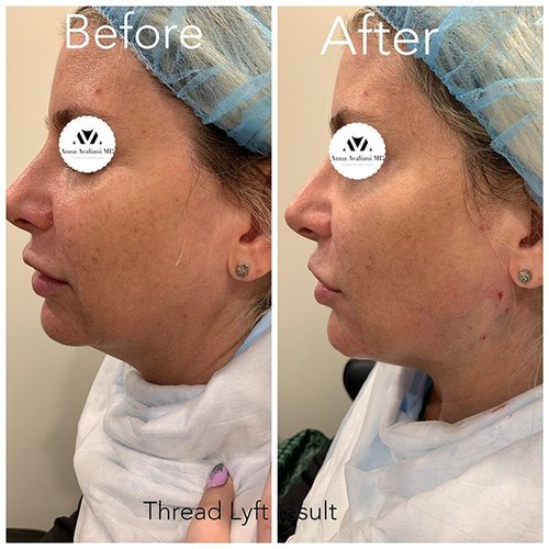 Face Threads Before and After - pdo1-nggid03208-ngg0dyn-600x600x100-00f0w010c010r110f110r010t010