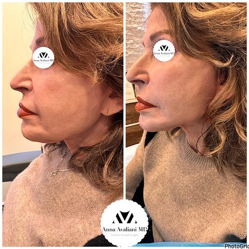 Face Threads Before and After - pdo2-nggid03209-ngg0dyn-600x600x100-00f0w010c010r110f110r010t010