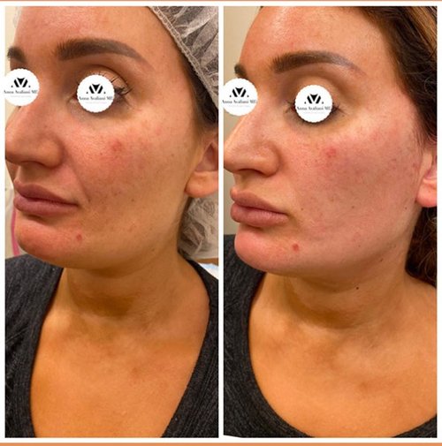 Face Threads Before and After - pdo3-nggid03210-ngg0dyn-600x600x100-00f0w010c010r110f110r010t010