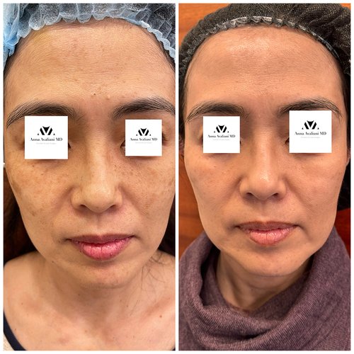 Picosure / Laser Skin Rejuvenation Before and After - pico1