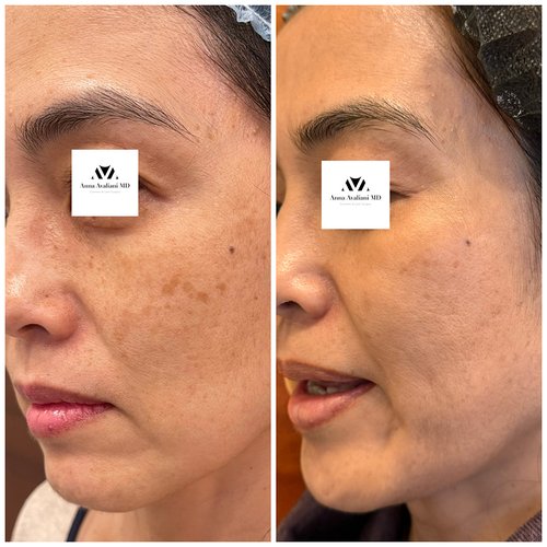Picosure / Laser Skin Rejuvenation Before and After - pico2