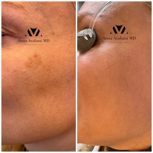 Picosure / Laser Skin Rejuvenation Before and After - pico3