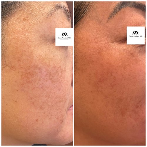 Picosure / Laser Skin Rejuvenation Before and After - pico4