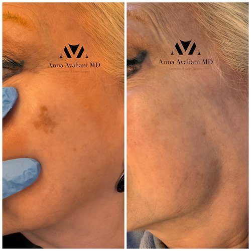 Picosure / Laser Skin Rejuvenation Before and After - pico5