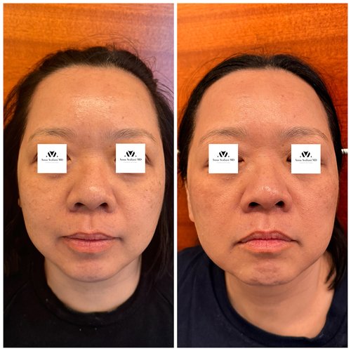 Picosure / Laser Skin Rejuvenation Before and After - pico6