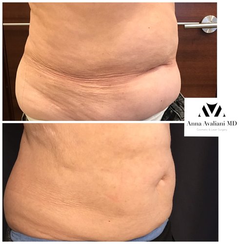 SculpSure Before and After - sc1
