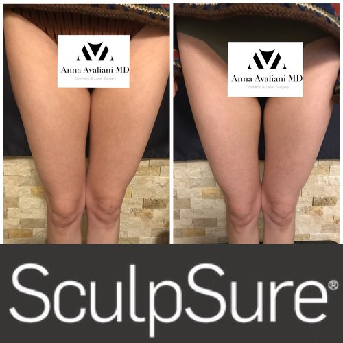 SculpSure Before and After - sc10