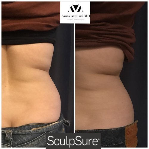 SculpSure Before and After - sc11