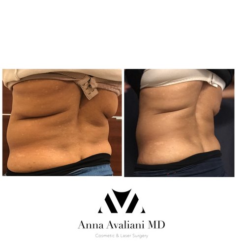 SculpSure Before and After - sc12