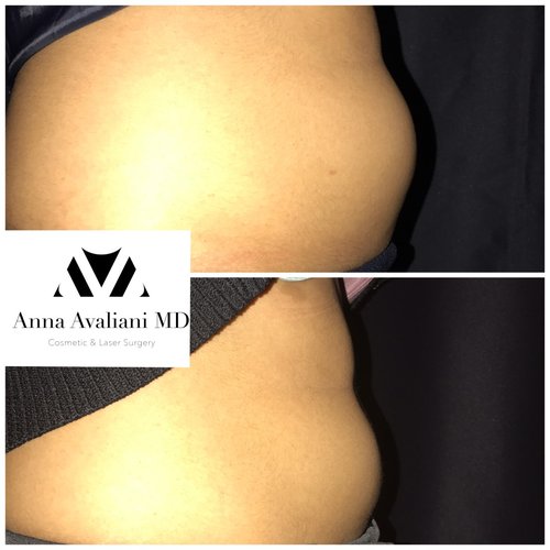 SculpSure Before and After - sc13