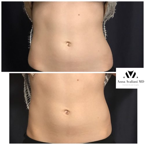 SculpSure Before and After - sc14