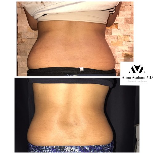 SculpSure Before and After - sc2