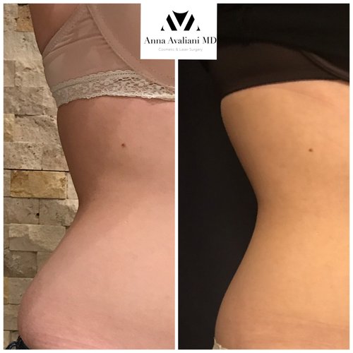 SculpSure Before and After - sc3