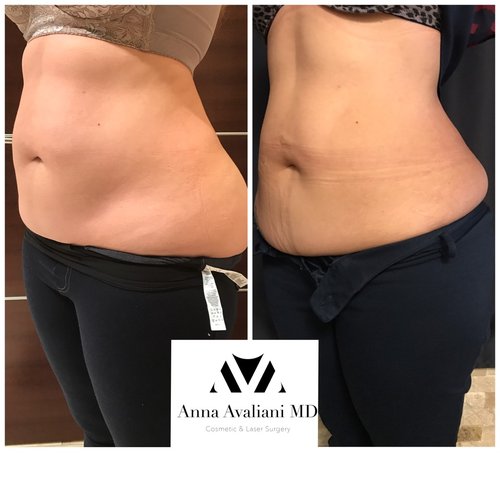 SculpSure Before and After - sc4