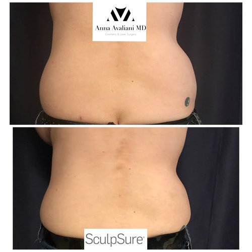 SculpSure Before and After - sc5