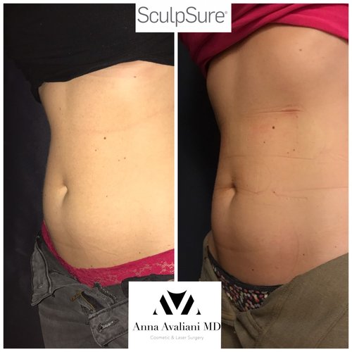 SculpSure Before and After - sc6