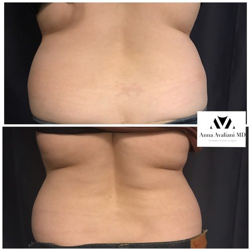 SculpSure Before and After - sc7