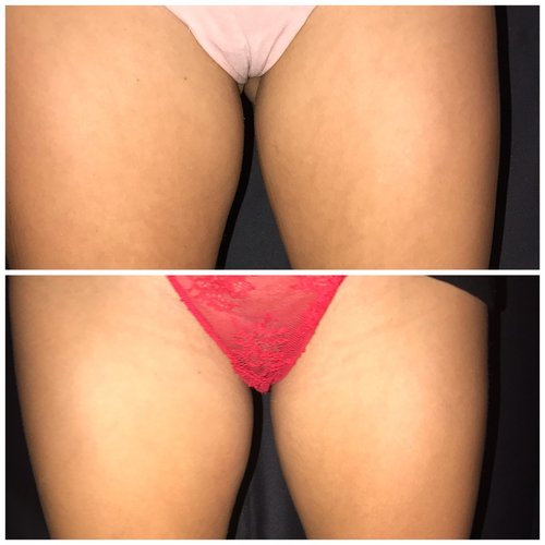 SculpSure Before and After - sc8