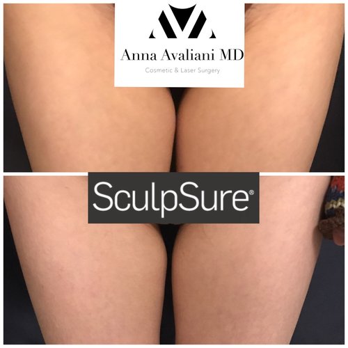 SculpSure Before and After - sc9
