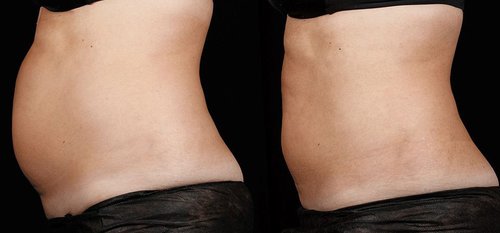 SculpSure Before and After - sg1