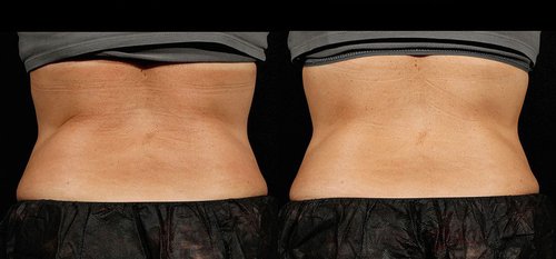 SculpSure Before and After - sg2