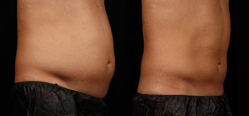 SculpSure Before and After - sg3