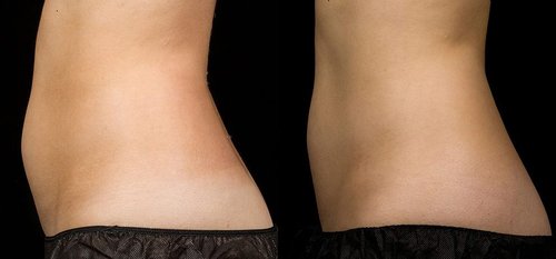 SculpSure Before and After - sg5