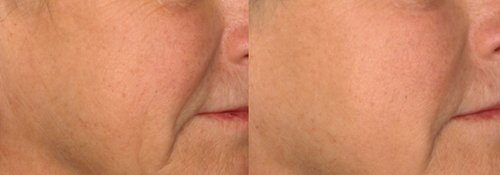 Picosure / Laser Skin Rejuvenation Before and After - skin1
