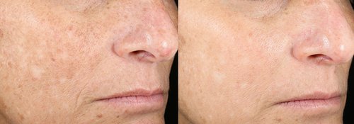 Picosure / Laser Skin Rejuvenation Before and After - skin10