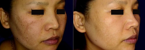 Picosure / Laser Skin Rejuvenation Before and After - skin2